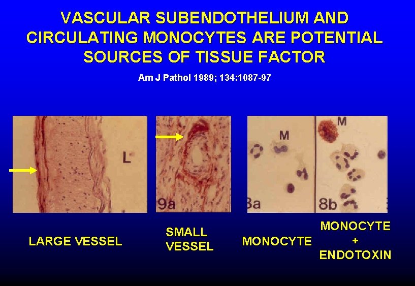 VASCULAR SUBENDOTHELIUM AND CIRCULATING MONOCYTES ARE POTENTIAL SOURCES OF TISSUE FACTOR Am J Pathol