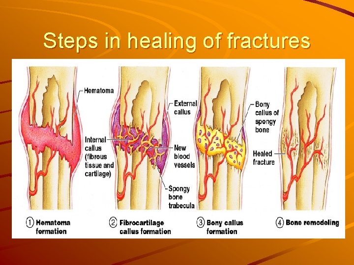 Steps in healing of fractures 