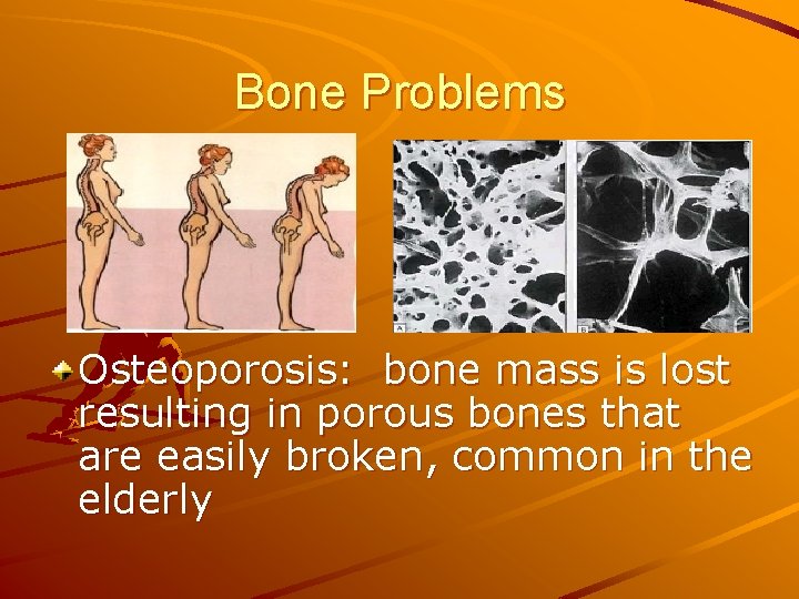 Bone Problems Osteoporosis: bone mass is lost resulting in porous bones that are easily