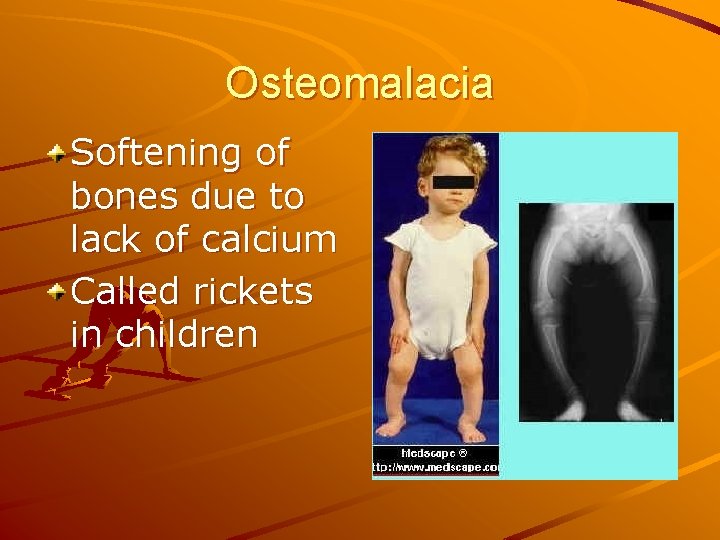 Osteomalacia Softening of bones due to lack of calcium Called rickets in children 