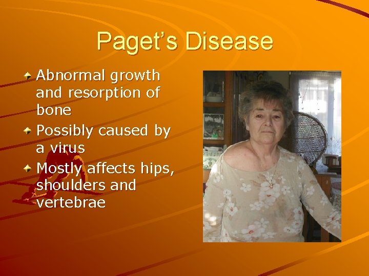 Paget’s Disease Abnormal growth and resorption of bone Possibly caused by a virus Mostly