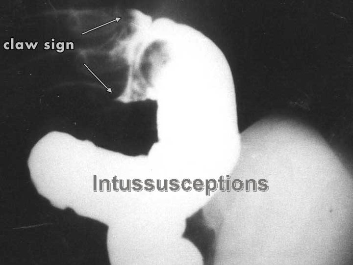 Apple core Colitis Intussusceptions Volvulus “coffe bean” Intussusceptions 