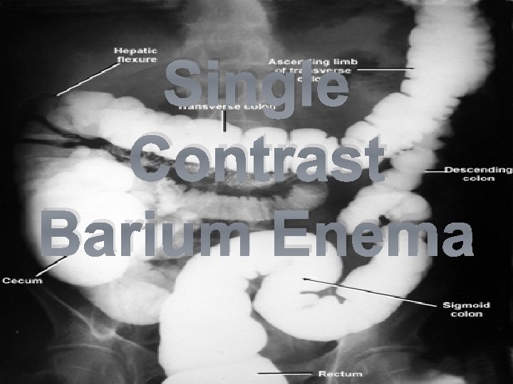 Single Contrast Barium Enema 