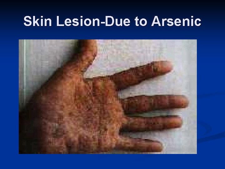 Skin Lesion-Due to Arsenic 