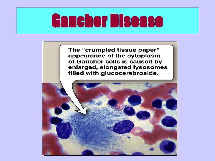 Gaucher Disease 