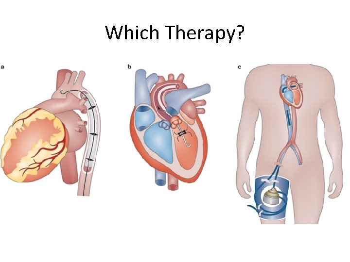 Which Therapy? 