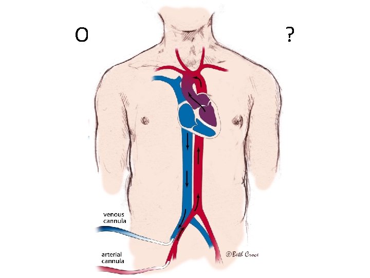 Or Is it Time for ECMO ? 