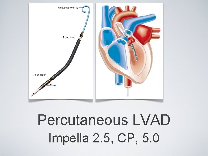Percutaneous LVAD Impella 2. 5, CP, 5. 0 