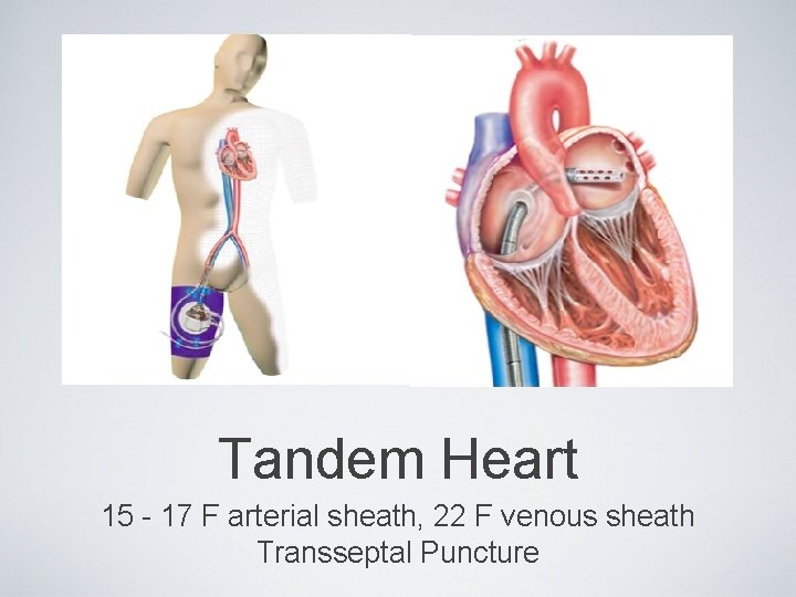Tandem Heart 15 - 17 F arterial sheath, 22 F venous sheath Transseptal Puncture