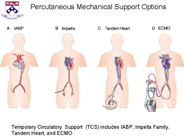 Percutaneous Mechanical Support Options Temporary Circulatory Support (TCS) includes IABP, Impella Family, Tandem Heart,