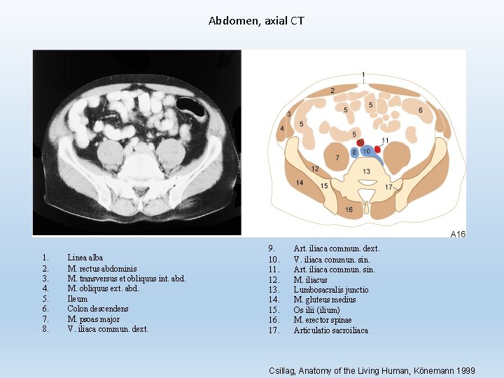 Abdomen, axial CT 1. 2. 3. 4. 5. 6. 7. 8. Linea alba M.