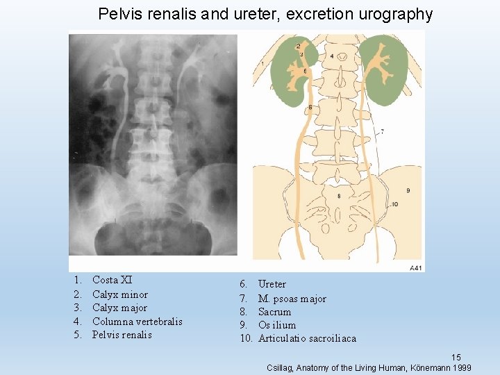 Pelvis renalis and ureter, excretion urography 1. 2. 3. 4. 5. Costa XI Calyx