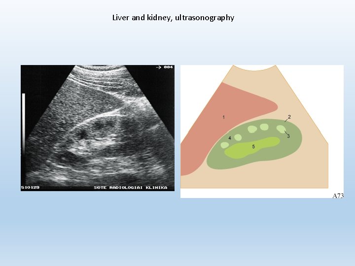 Liver and kidney, ultrasonography 
