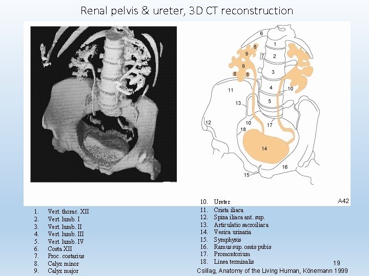 Renal pelvis & ureter, 3 D CT reconstruction 1. 2. 3. 4. 5. 6.