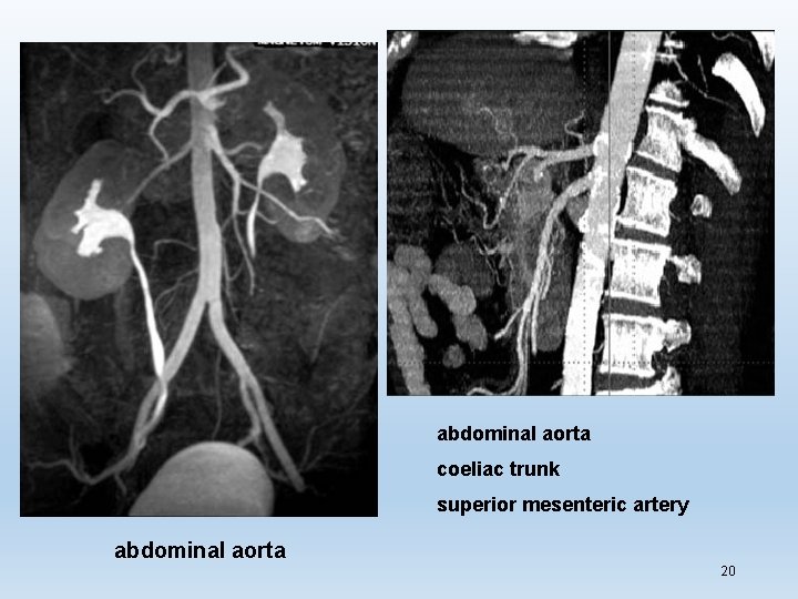 abdominal aorta coeliac trunk superior mesenteric artery abdominal aorta 20 