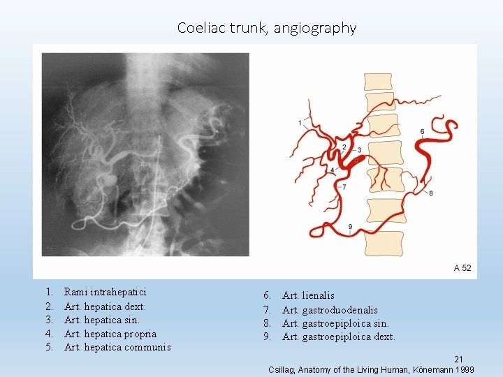 Coeliac trunk, angiography 1. 2. 3. 4. 5. Rami intrahepatici Art. hepatica dext. Art.
