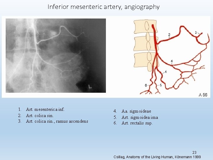 Inferior mesenteric artery, angiography 1. Art. mesenterica inf. 2. Art. colica sin. 3. Art.