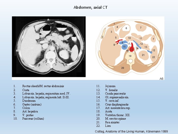 Abdomen, axial CT 1. 2. 3. 4. 5. 6. 7. 8. 9. 10. Rectus