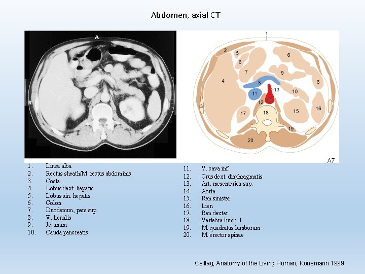Abdomen, axial CT 1. 2. 3. 4. 5. 6. 7. 8. 9. 10. Linea