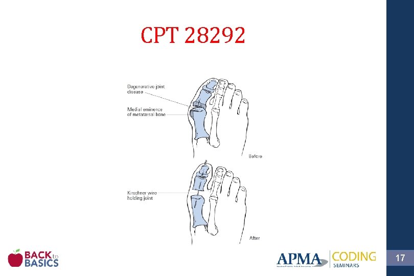 CPT 28292 17 