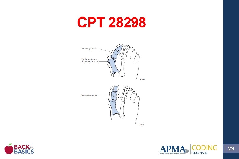 CPT 28298 29 