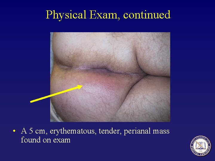 Physical Exam, continued • A 5 cm, erythematous, tender, perianal mass found on exam