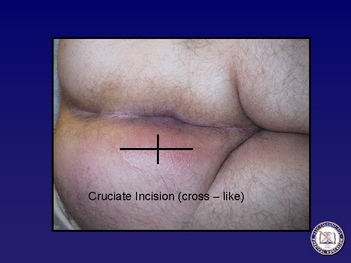 Cruciate Incision (cross – like) 