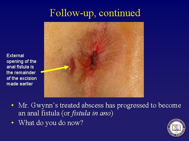 Follow-up, continued External opening of the anal fistula is the remainder of the excision