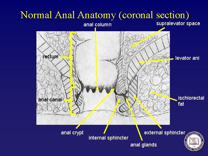Normal Anatomy (coronal section) anal column supralevator space rectum levator ani ischiorectal fat anal