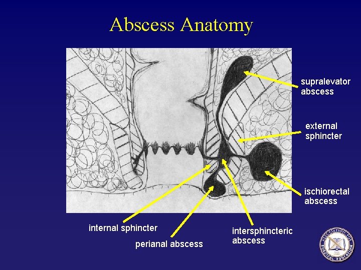 Abscess Anatomy supralevator abscess external sphincter ischiorectal abscess internal sphincter perianal abscess intersphincteric abscess