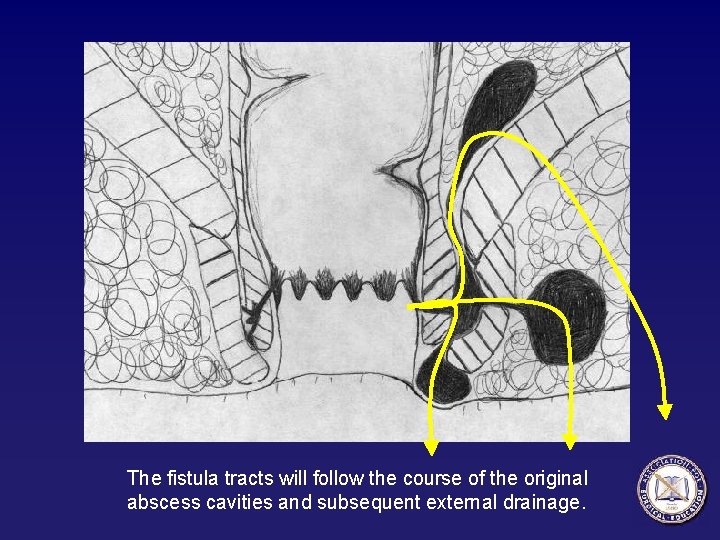 The fistula tracts will follow the course of the original abscess cavities and subsequent