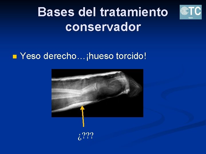 Bases del tratamiento conservador n Yeso derecho…¡hueso torcido! ¿? ? ? 