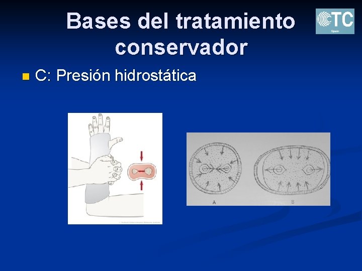 Bases del tratamiento conservador n C: Presión hidrostática 