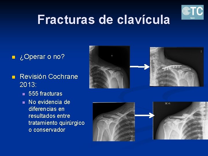 Fracturas de clavícula n ¿Operar o no? n Revisión Cochrane 2013: n n 555