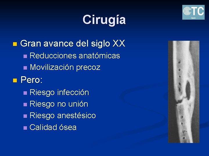 Cirugía n Gran avance del siglo XX Reducciones anatómicas n Movilización precoz n n