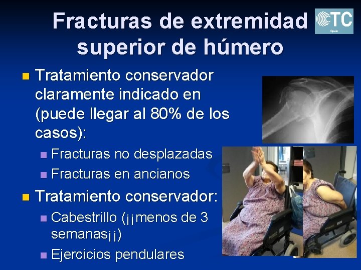 Fracturas de extremidad superior de húmero n Tratamiento conservador claramente indicado en (puede llegar