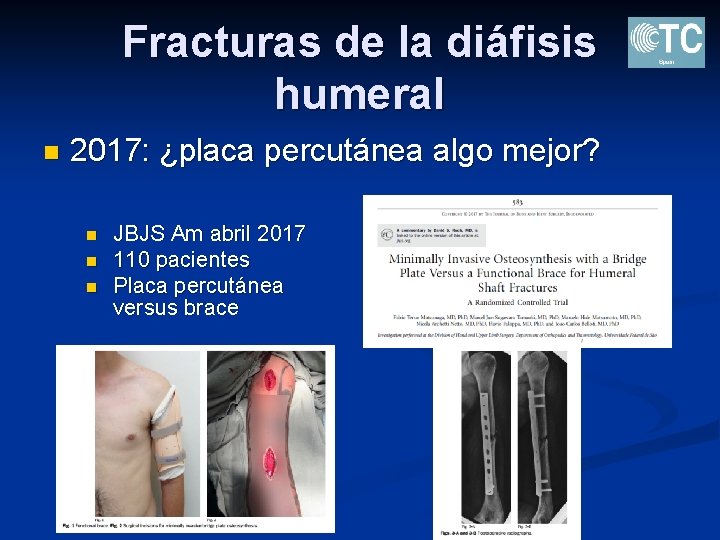 Fracturas de la diáfisis humeral n 2017: ¿placa percutánea algo mejor? n n n