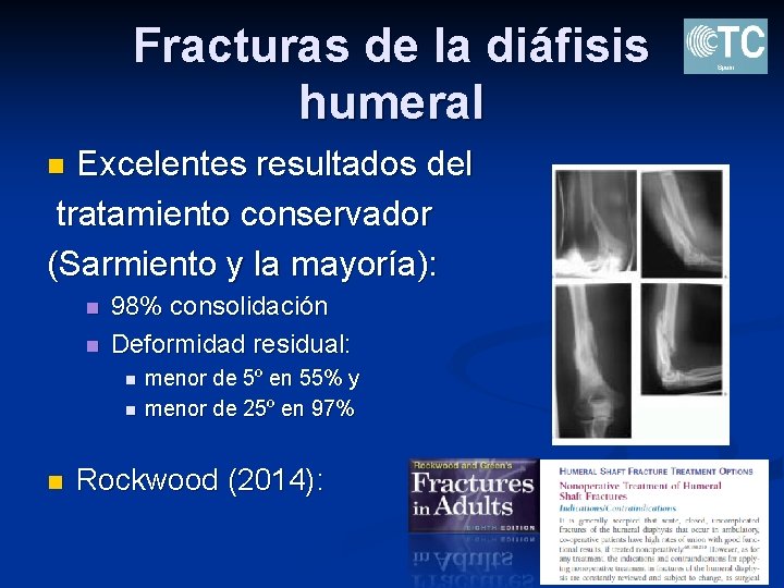 Fracturas de la diáfisis humeral Excelentes resultados del tratamiento conservador (Sarmiento y la mayoría):