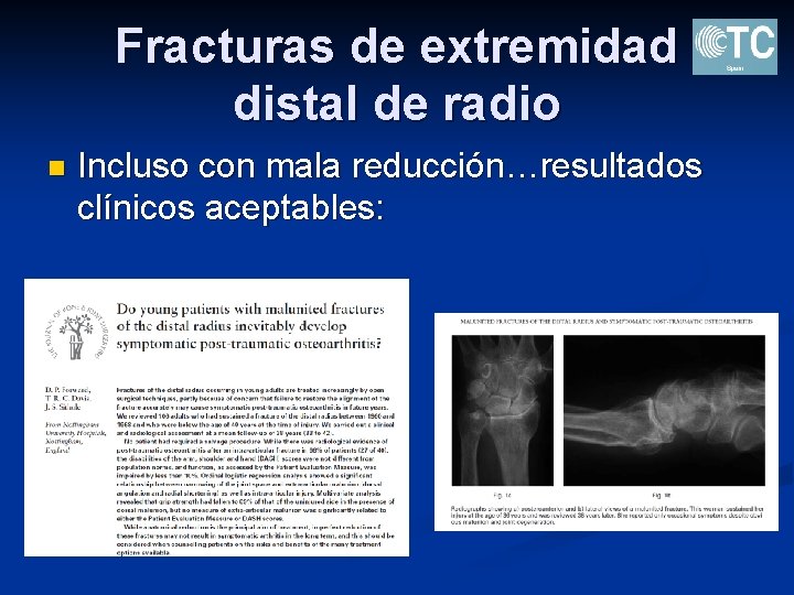 Fracturas de extremidad distal de radio n Incluso con mala reducción…resultados clínicos aceptables: 