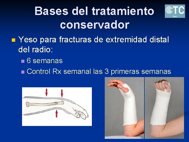 Bases del tratamiento conservador n Yeso para fracturas de extremidad distal del radio: 6