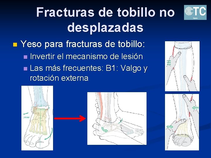 Fracturas de tobillo no desplazadas n Yeso para fracturas de tobillo: Invertir el mecanismo