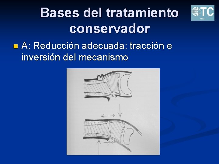 Bases del tratamiento conservador n A: Reducción adecuada: tracción e inversión del mecanismo 