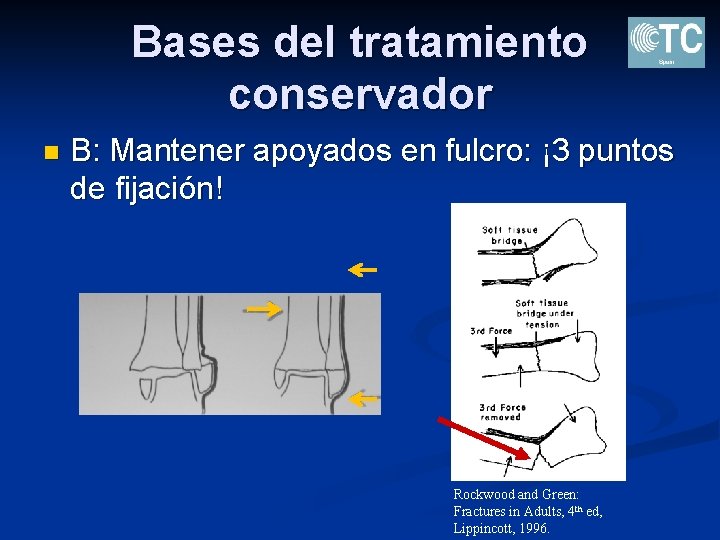 Bases del tratamiento conservador n B: Mantener apoyados en fulcro: ¡ 3 puntos de