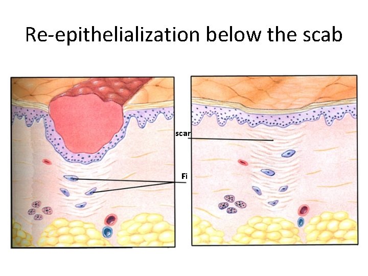 Re-epithelialization below the scab scar Fi 