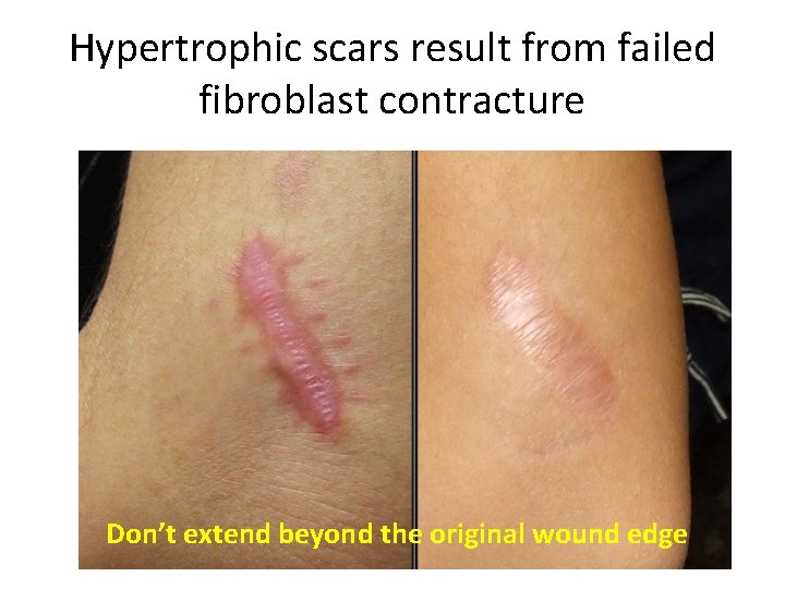 Hypertrophic scars result from failed fibroblast contracture Don’t extend beyond the original wound edge