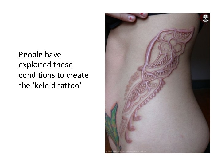 People have exploited these conditions to create the ‘keloid tattoo’ 