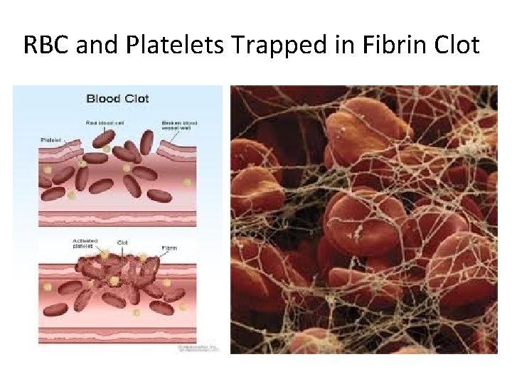 RBC and Platelets Trapped in Fibrin Clot 