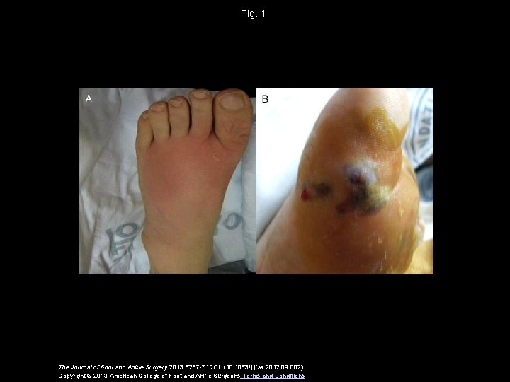 Fig. 1 The Journal of Foot and Ankle Surgery 2013 5267 -71 DOI: (10.