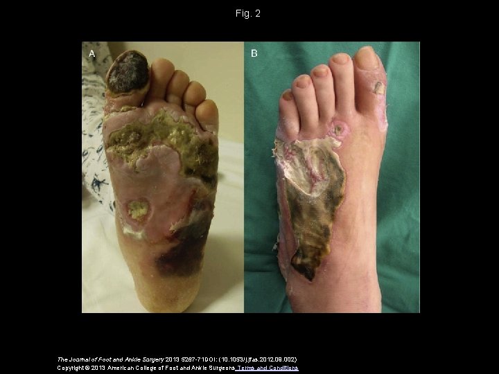 Fig. 2 The Journal of Foot and Ankle Surgery 2013 5267 -71 DOI: (10.