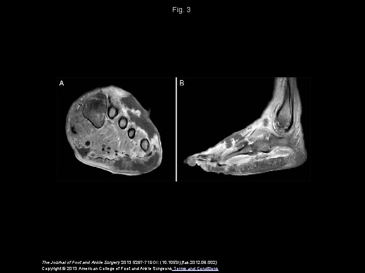 Fig. 3 The Journal of Foot and Ankle Surgery 2013 5267 -71 DOI: (10.